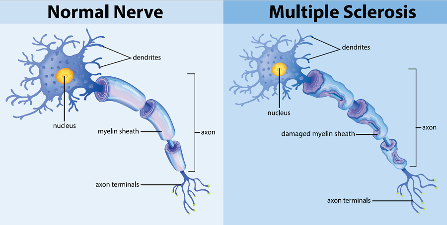 Two images, one of a healthy nerve cell and one with a myelin sheath damaged by MS.