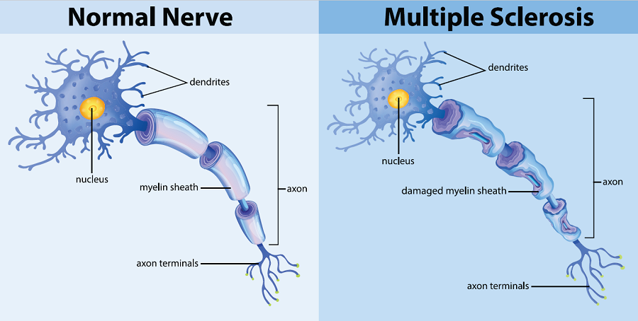 Definition Of MS National Multiple Sclerosis Society