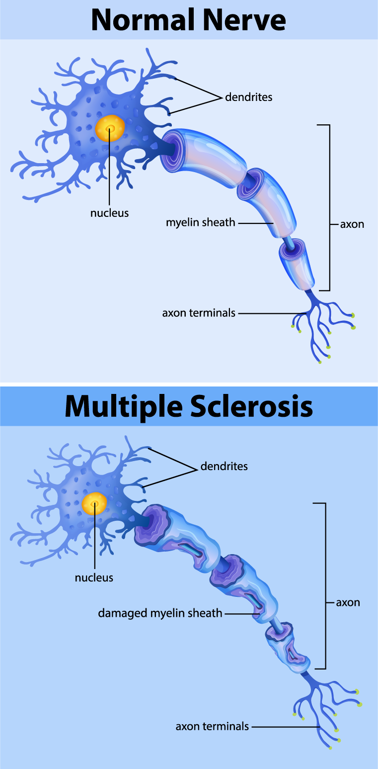 two diagrams, one showing a healthy nerve and the other one showing damage from multiple sclerosis