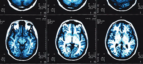 explain multiple sclerosis brain mri
